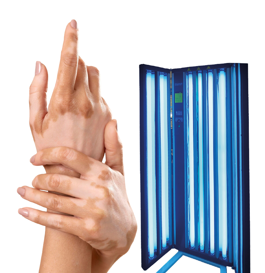 Tratamiento Vitiligo y Psoriasis