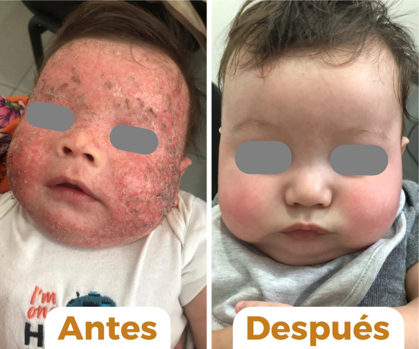 Dermatitis atópica